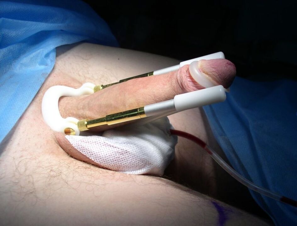 阴茎增大手术后的延长器